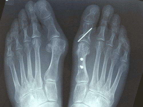 Bilateral AP foot X-ray showing hallux valgus with scarf osteotomy correction