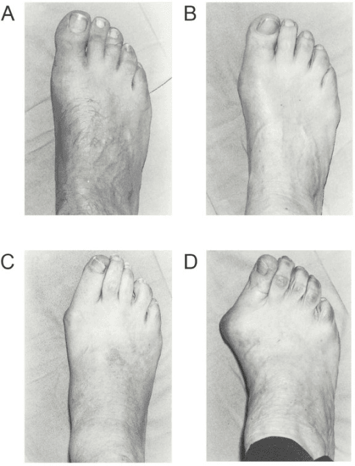 Manchester Scale clinical photographs showing hallux valgus severity grades