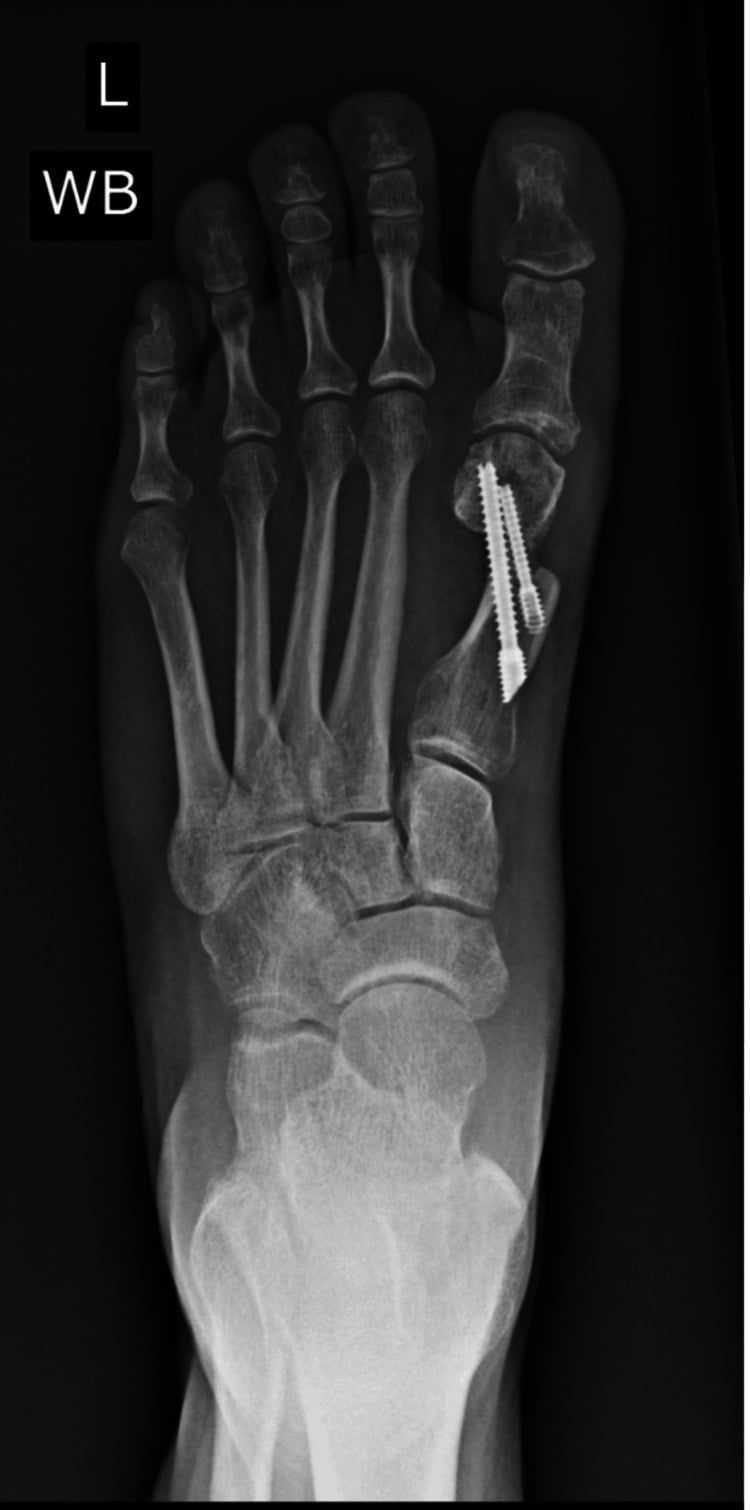 Weightbearing AP foot radiograph demonstrating post-surgical hallux varus deformity