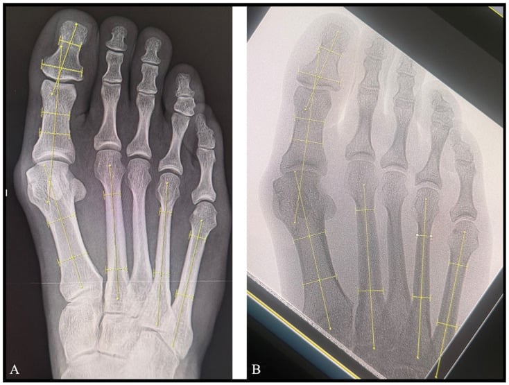 Weightbearing AP foot radiograph demonstrating HVA and IMA angle measurements