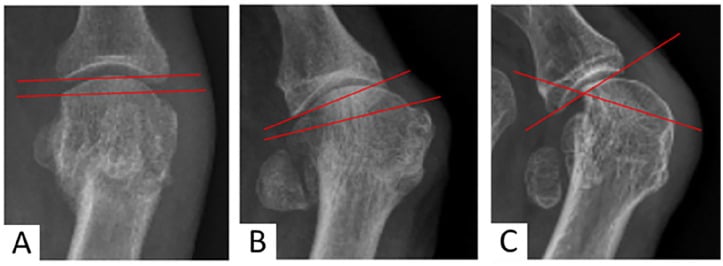 Radiographs demonstrating sesamoid subluxation and Hardy and Clapham classification
