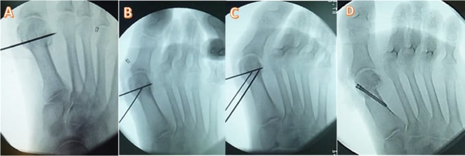 Intraoperative fluoroscopy of distal metatarsal Chevron osteotomy