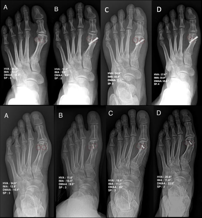 Weightbearing AP foot radiographs comparing baseline vs postoperative hallux valgus correction