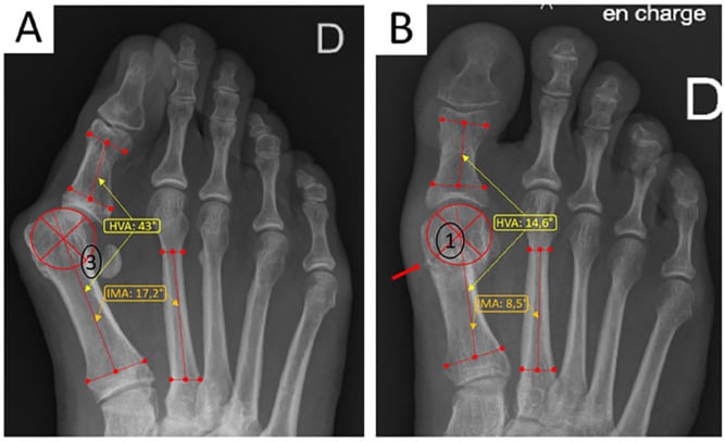 Weightbearing AP foot radiographs showing preop vs postop hallux valgus correction