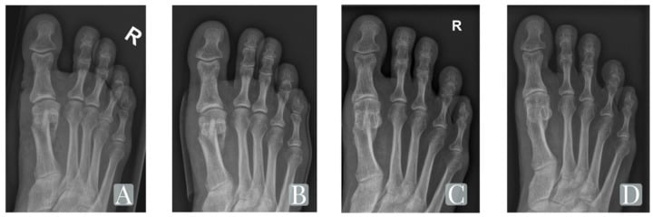 Weightbearing AP foot radiographs of Chevron osteotomy bio-screw fixation
