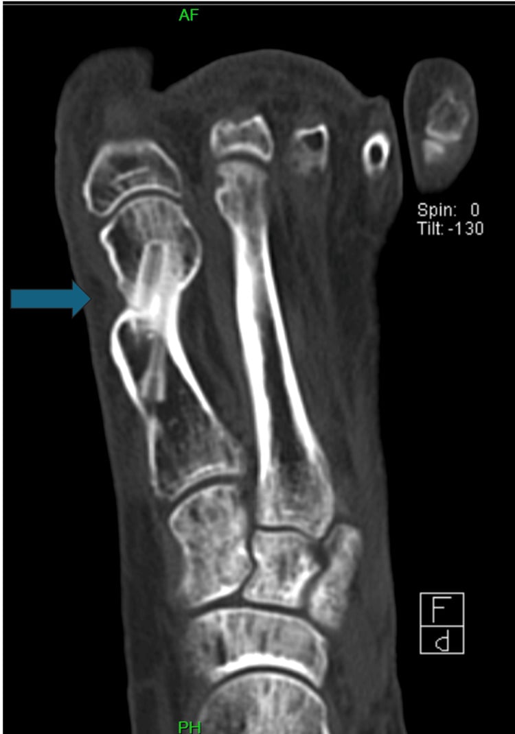 Coronal CT image confirming 1st metatarsal head nonunion