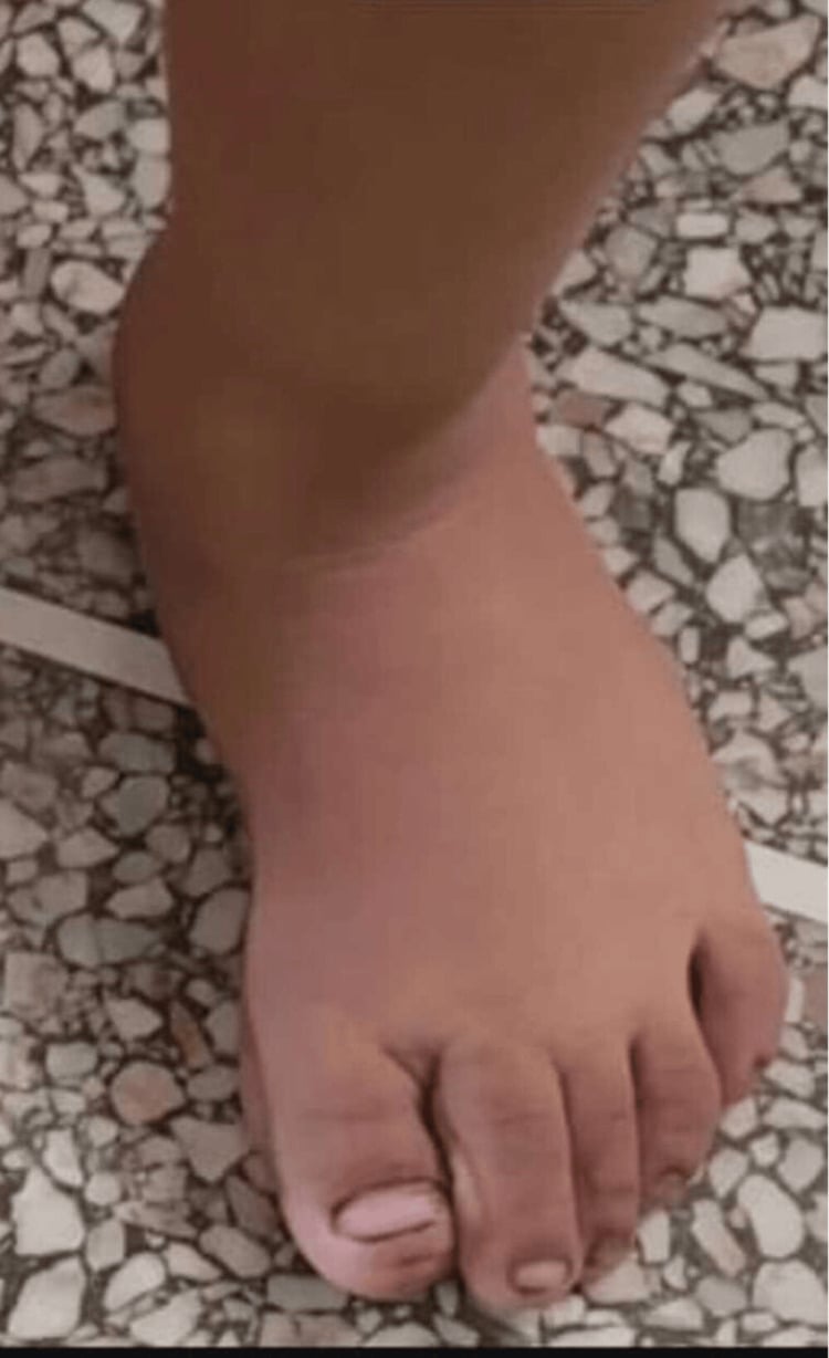 Follow-up appearance after correction of congenital hallux varus, the great toe aligned with the lesser toes.