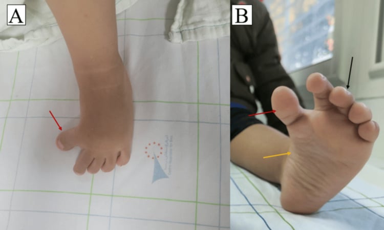 Two clinical views, A and B, of congenital hallux varus in a child, with arrows marking the medially deviated great toe.
