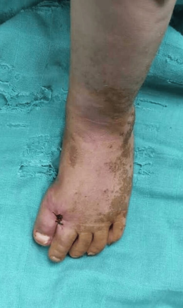 Early postoperative appearance after correction of congenital hallux varus, with a sutured wound at the base of the great toe.