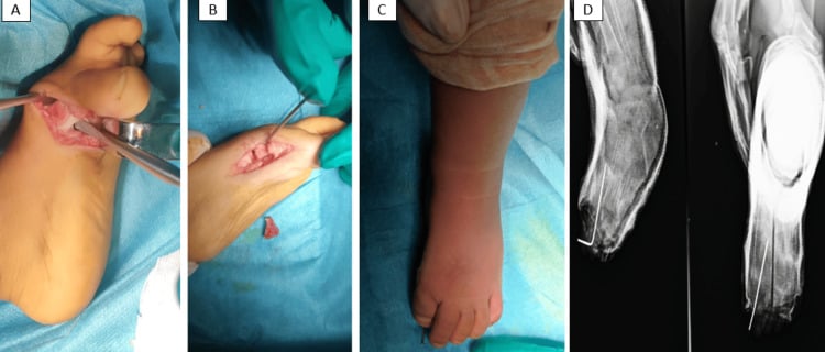 Operative correction of congenital hallux varus in four panels, with K-wire stabilisation on the radiographs.