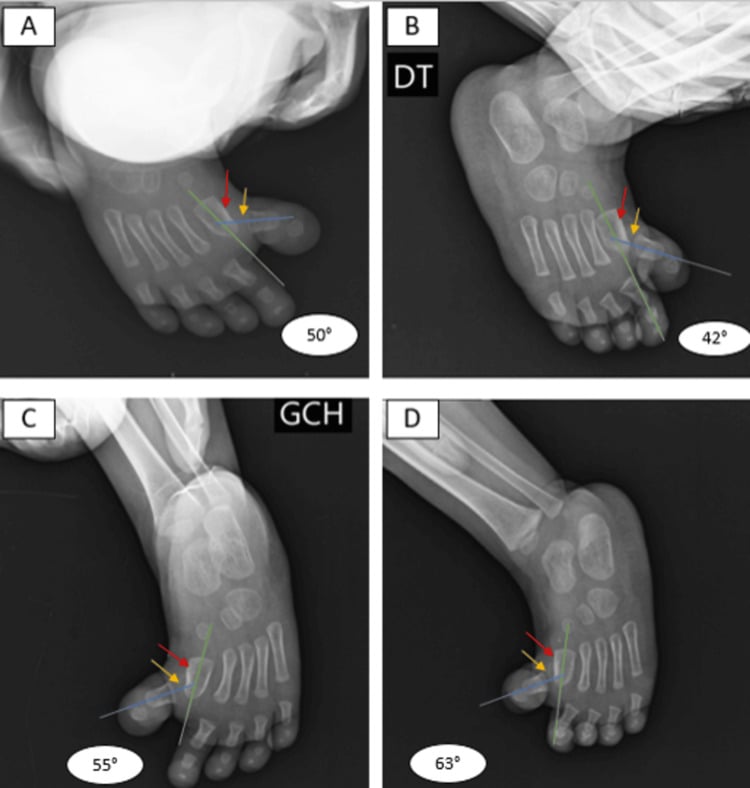 Four radiographs, A to D, of congenital hallux varus in a young child (a 19-month-old, per the source), with axis lines and printed angles.