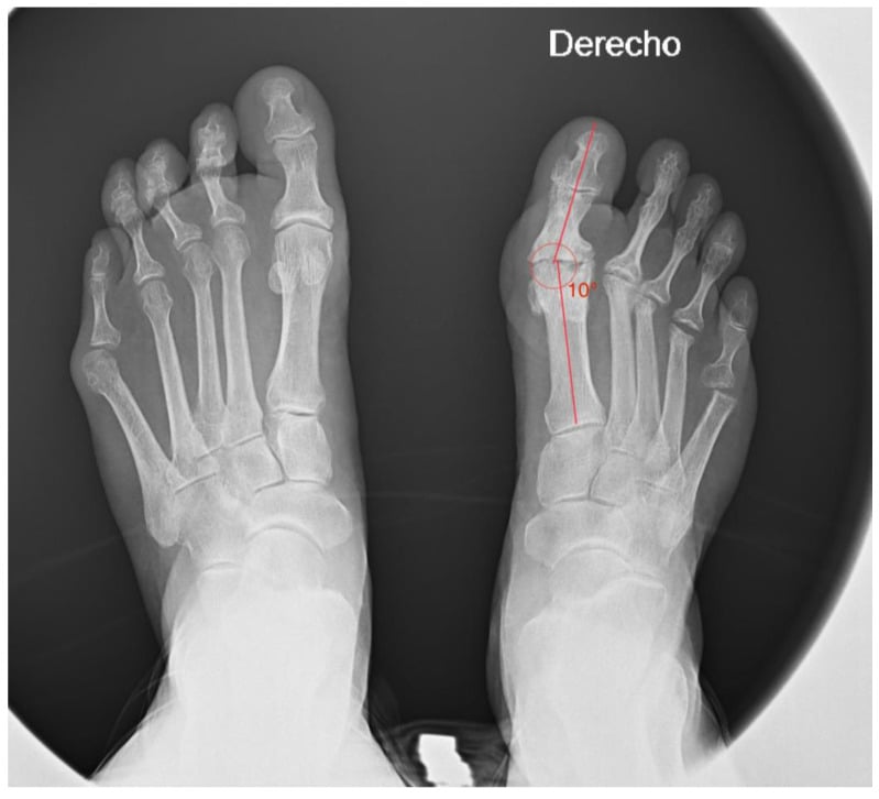 Radiograph of both feet, the hallux angle marked at 10 degrees on the foot labelled Derecho.