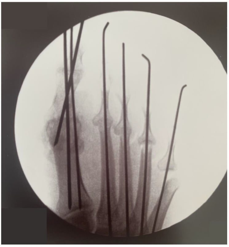 Fluoroscopic image of K-wires in the first ray and the lesser toes.