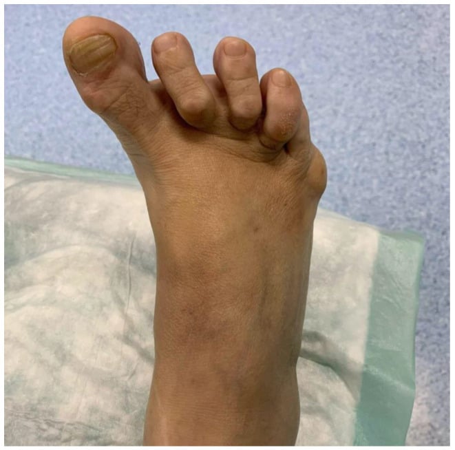 Adult hallux varus with crowded, overlapping lesser toes.