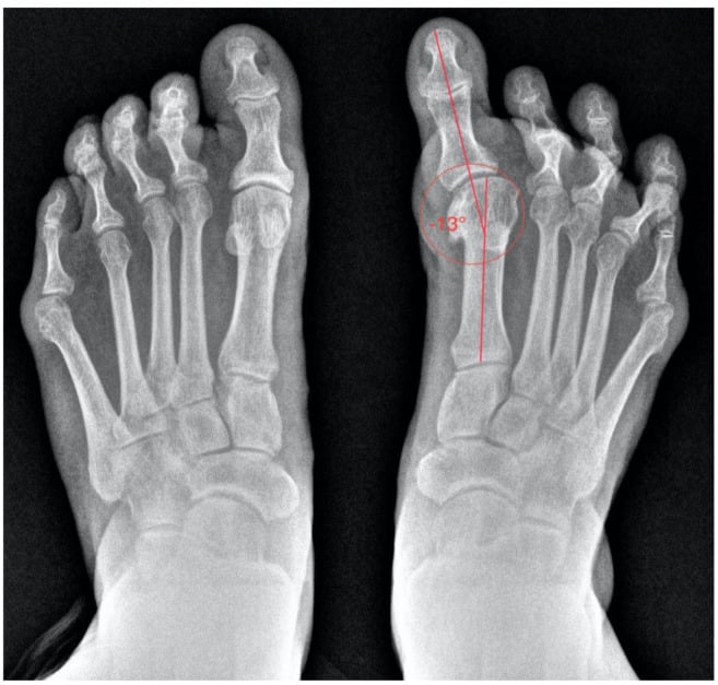 Radiographs of both feet, the hallux angle marked at minus 13 degrees on one foot.