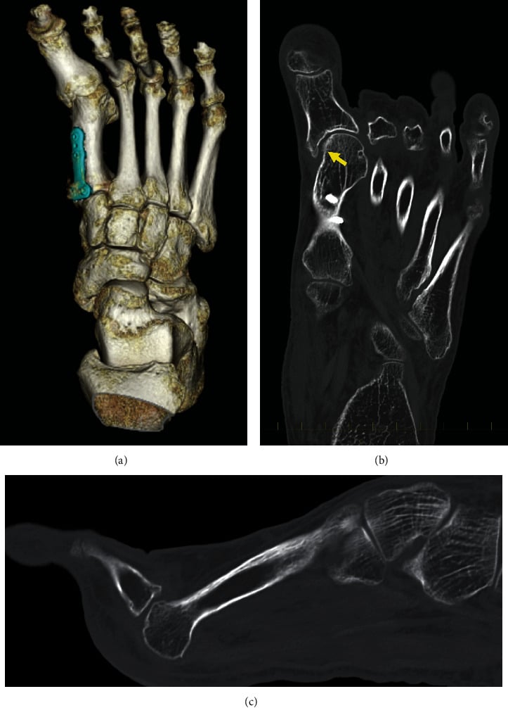 CT of a forefoot with a plate on the first metatarsal: a three-dimensional reconstruction and two slices, the arrow at the first metatarsophalangeal joint.