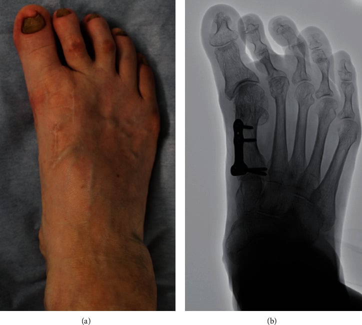 Clinical photograph and radiograph of hallux varus before reconstruction, with a plate on the first metatarsal.