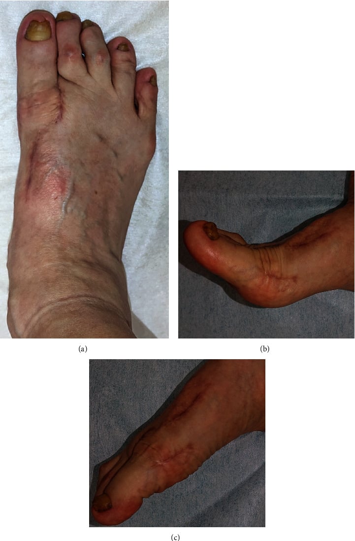 Clinical views after ligament reconstruction showing hallux alignment and the great toe in two positions.