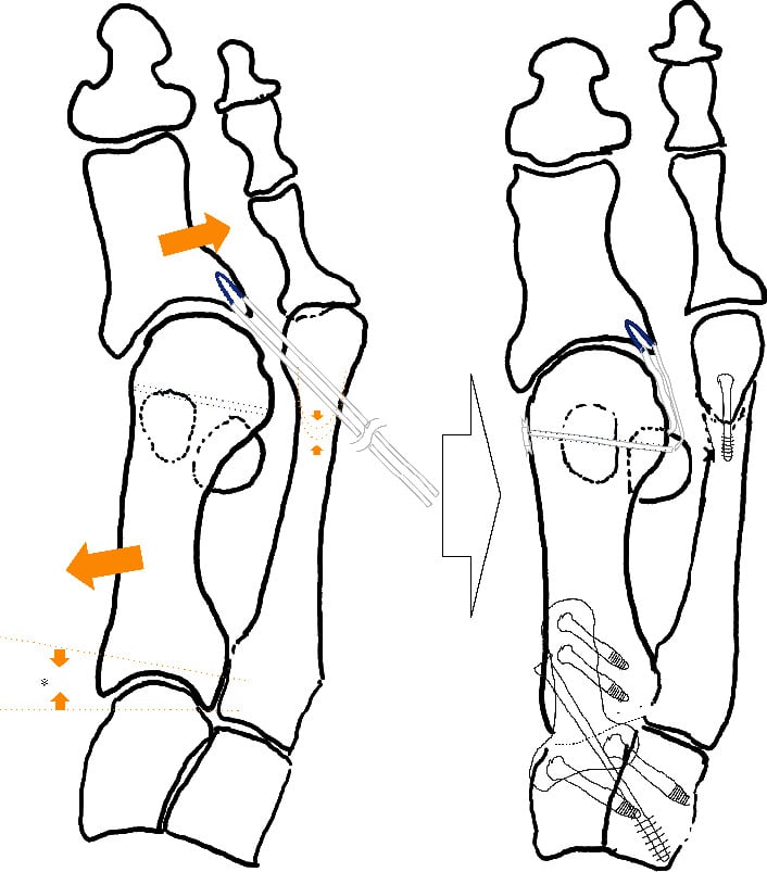 Schematic of lateral collateral ligament reconstruction for hallux varus, before and after.