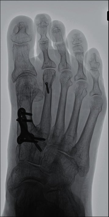 Radiograph after lateral ligament reconstruction with the hallux aligned.