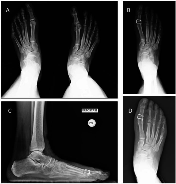 Radiographs in four panels around first MTP arthrodesis, three showing an implant across the first metatarsophalangeal joint.