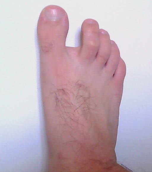 Clinical photograph of a foot showing the great toe deviated medially away from the lesser toes, hallux varus.