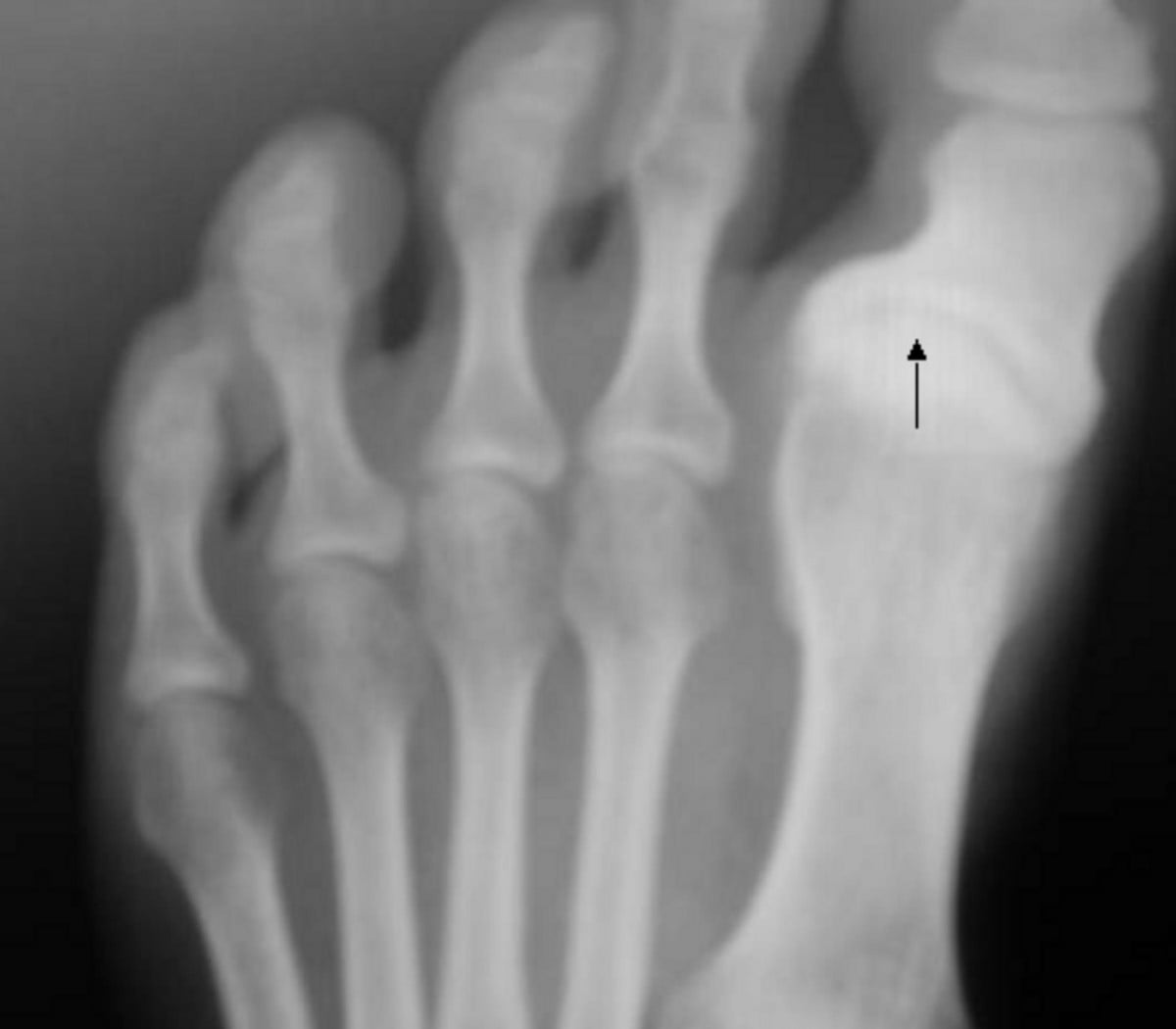 AP forefoot radiograph showing the great toe deviated medially at the first metatarsophalangeal joint, with widening of the first web space — hallux varus.
