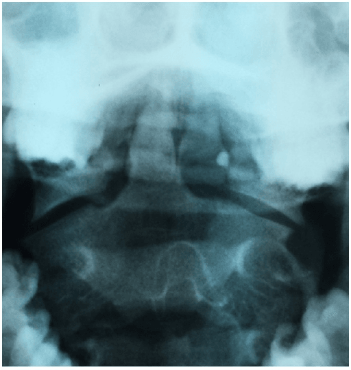 Anteroposterior open-mouth radiograph of the upper cervical spine after halo-vest removal.