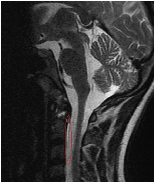 Sagittal MRI reconstruction of the cervical spine with marked narrow fluid compartment at C2-C3 and poor image quality.