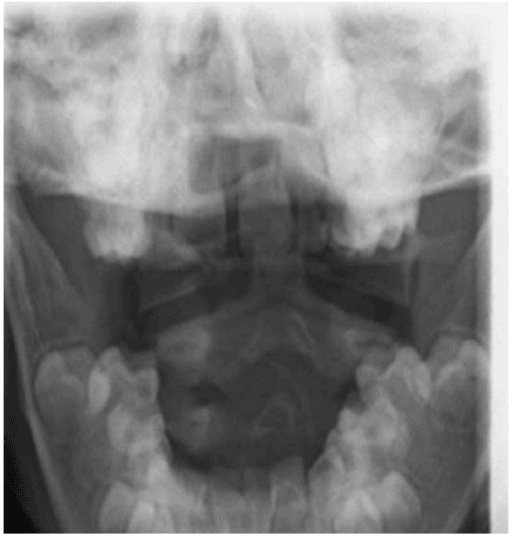 Open-mouth radiograph of the odontoid peg with a transverse lucency and lateral displacement.