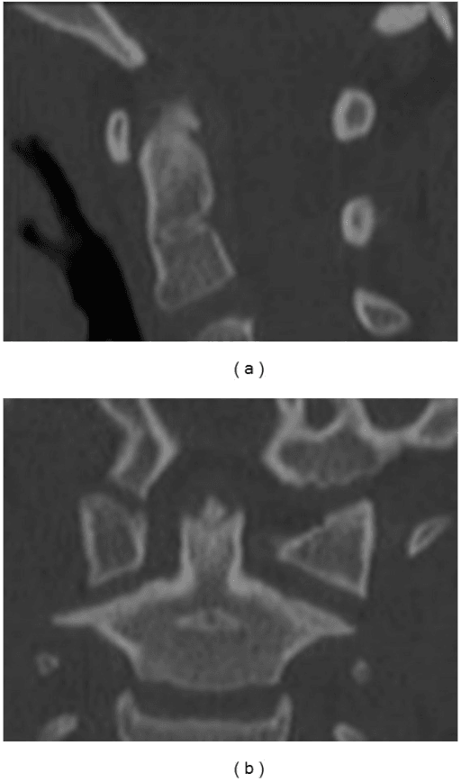 Sagittal and coronal reformatted CT images of a normal odontoid peg.