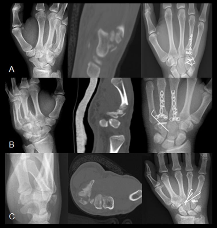 Three hamate-body fracture cases, rows A to C, each with preoperative radiograph, CT and postoperative fixation
