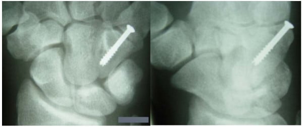 Three-month anteroposterior and oblique radiographs after screw fixation of a hamate-body fracture