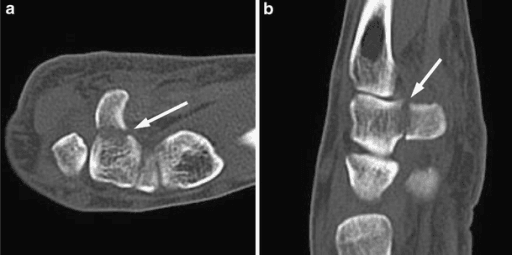 Multiplanar CT reconstruction showing hook of hamate fracture in axial and sagittal planes