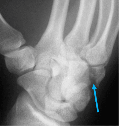 Pronated oblique 30-degree radiograph (carpal tunnel view) showing hook of hamate fracture