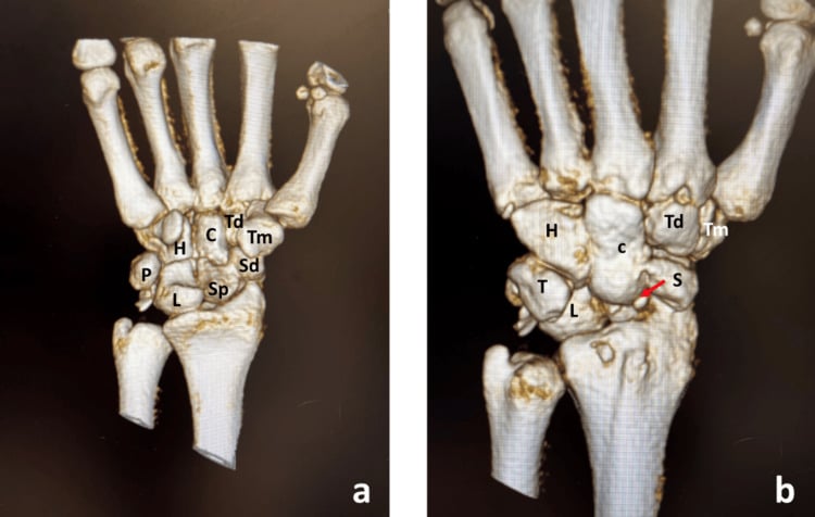 3D CT scan of hamate body fracture