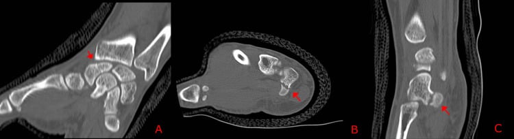Axial and coronal CT scans showing hook of hamate nonunion