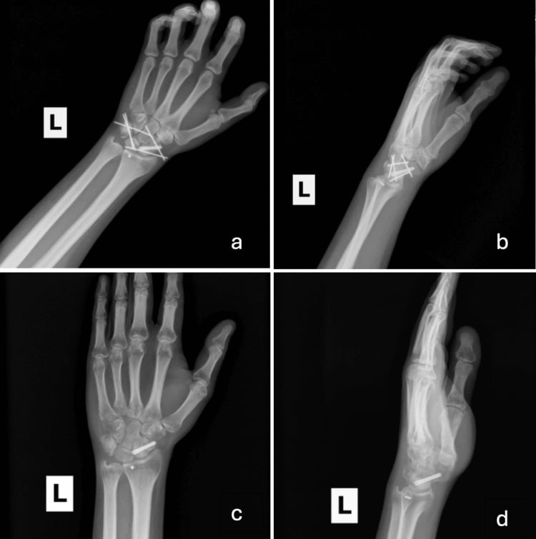 Radiographs of hamate-metacarpal fracture-dislocation before and after hardware removal