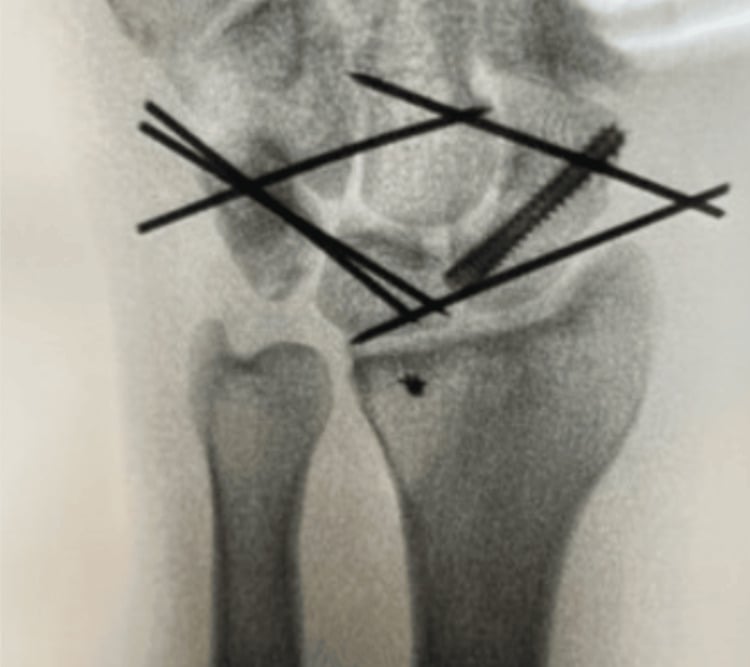 Intraoperative fluoroscopy of K-wire and screw fixation of hamate fracture