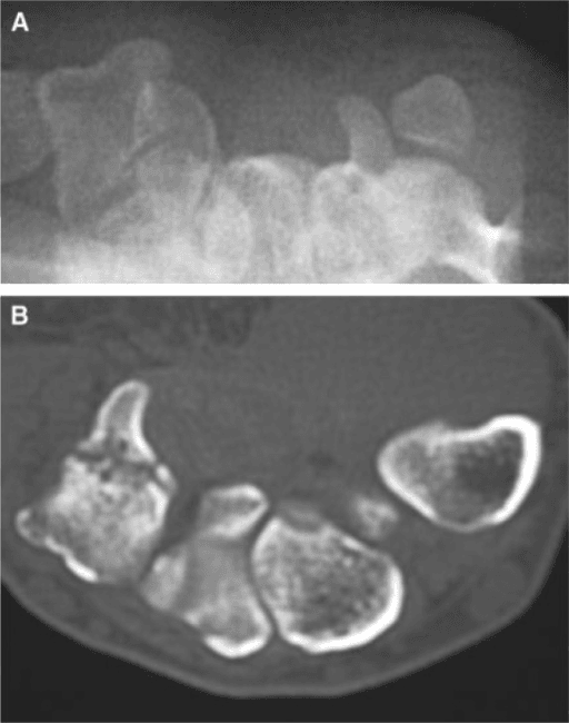 Two-panel comparison showing carpal tunnel view radiograph versus CT scan for hook of hamate fracture
