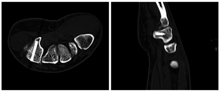 Axial and sagittal CT showing union after screw fixation of a hook-of-hamate fracture