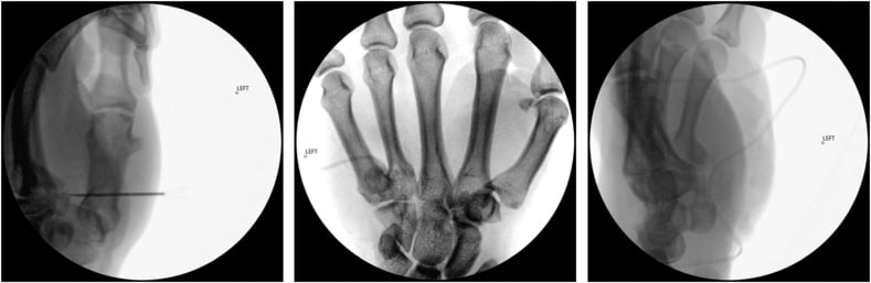 Three intraoperative fluoroscopic views of a left hand localising the hook of hamate with a radio-opaque marker before partial excision
