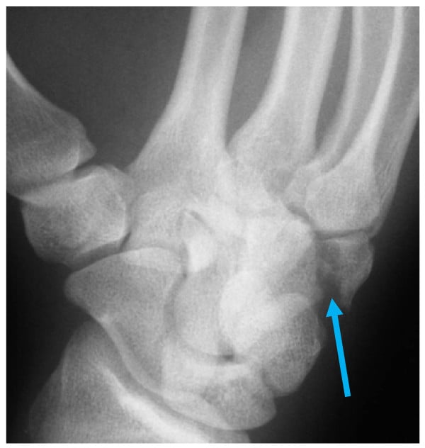 Pronated 30-degree oblique wrist radiograph showing a displaced hamate-body fracture marked by a blue arrow