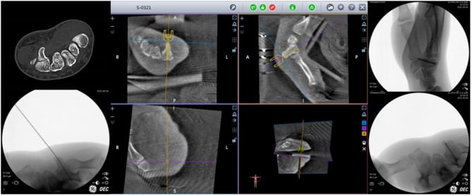 Preoperative CT, navigated guidewire planning and fluoroscopy for percutaneous hook fixation