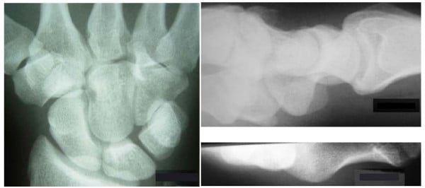 Anteroposterior, lateral and carpal tunnel radiographs from a missed hamate-body fracture