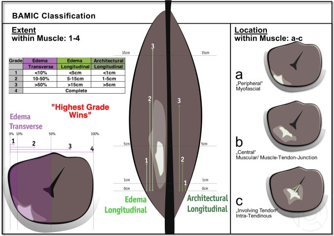 British Athletics Muscle Injury Classification diagram for MRI grading