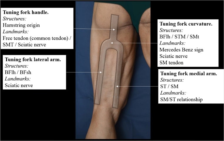 Inverted tuning-fork map for systematic ultrasound examination of the hamstrings