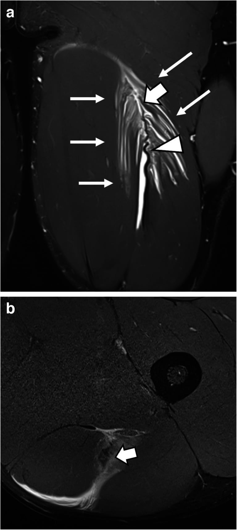 Coronal and axial MRI of high-grade biceps femoris injury with central tendon disruption