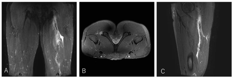 Coronal axial and sagittal MRI showing proximal conjoint tendon detachment