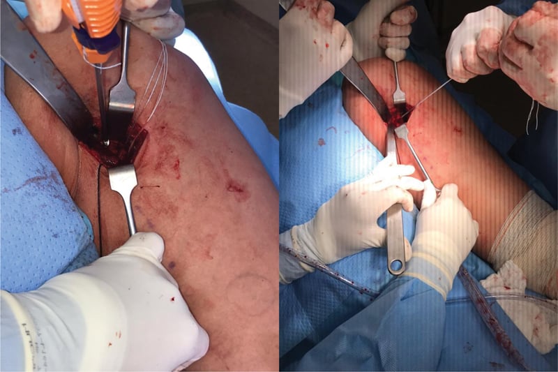 Insertion of three suture anchors into the ischial hamstring footprint